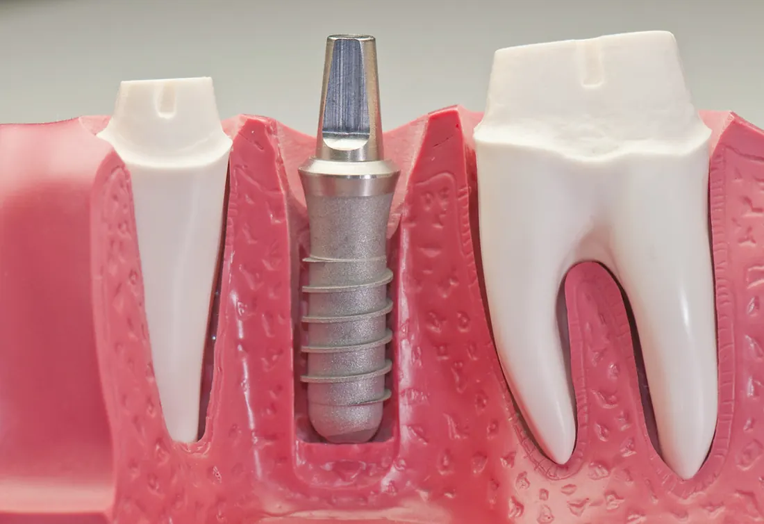 Modelo de implante dental (foto de stock)